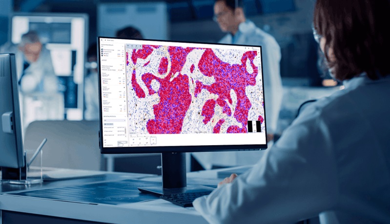 Aiforia tekoäly patologia